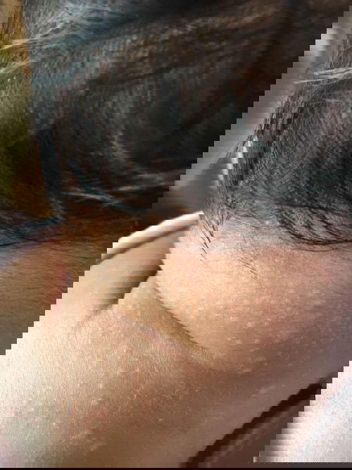 butlig2 sa mukha at leeg 1 month old and 20 days