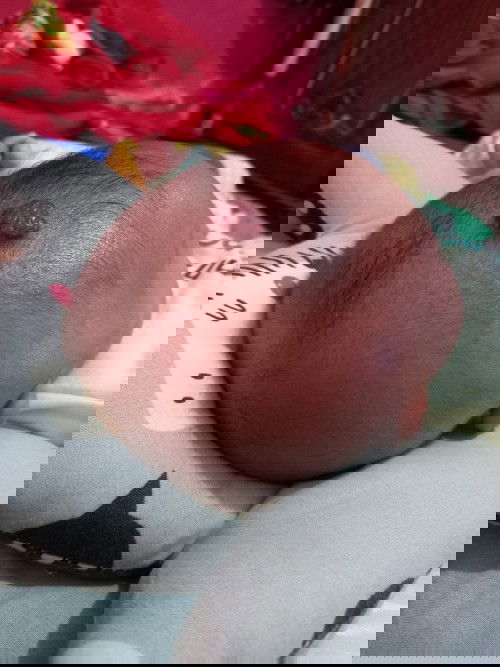 Apakah ada yg anaknya seperti ini namanya hemangioma