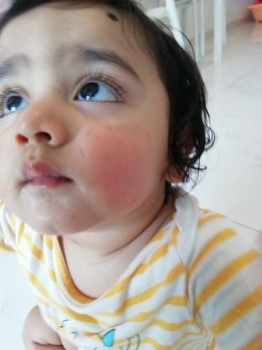 Rashes on baby cheeks