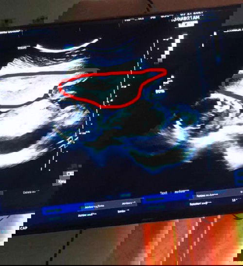 Contraction at 20 weeks