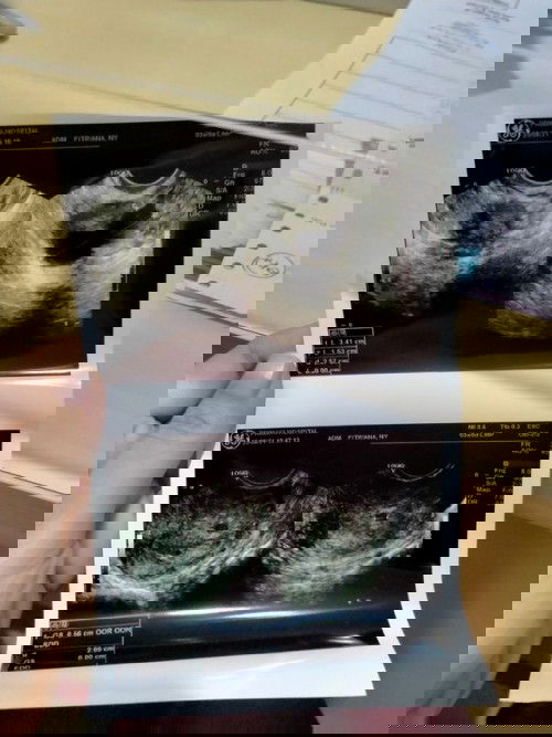 Defisiensi vit D salahsatu penyebab keguguranku.