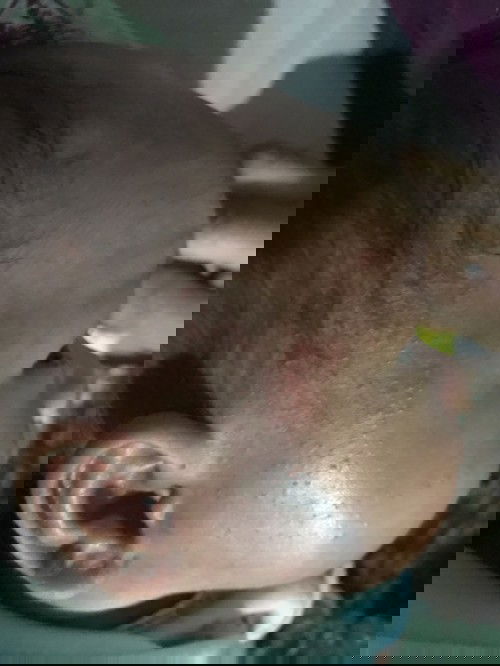 Bruntusan muka kepala