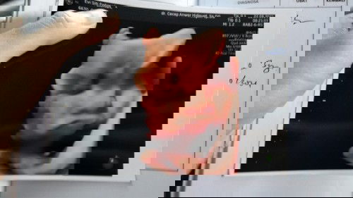 Kelilit tali pusat bayi 37w