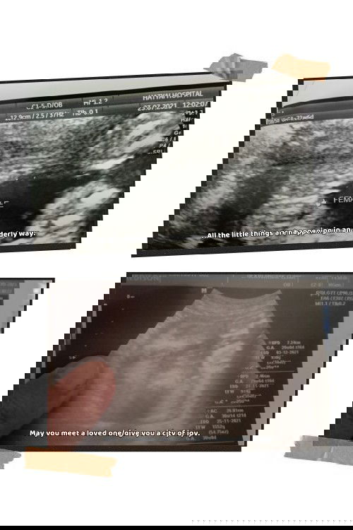 ลูกสาว100%แล้วใช่มั้ยค่ะแบบนี้😅 ภาพบนตอน5เดือน ภาพล่างตอน7เดือน