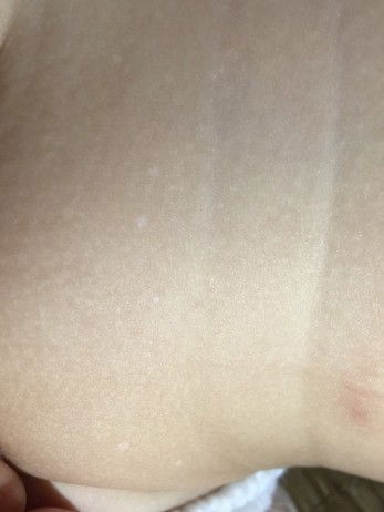 Da bé bị chấm trắng có bị sao không