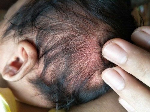 สอบถามหน่อยครับ มีผื่นหรือผดขึ้นบริเวณศีรษะลูก