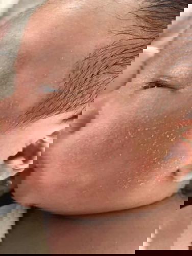 Worried about the rashes on his face