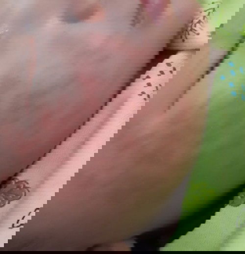 Muka bayi merah bintik" dan gatal