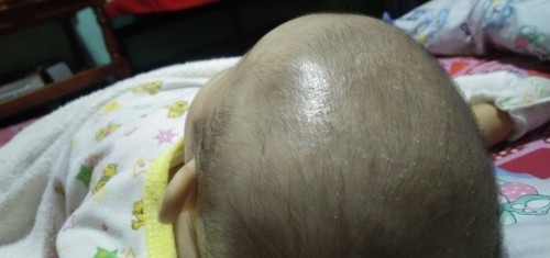 Cradle cap