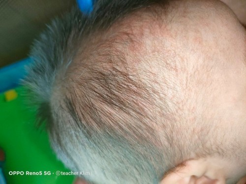 Rashes or bungang araw?