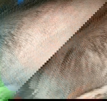 Rashes or bungang araw?