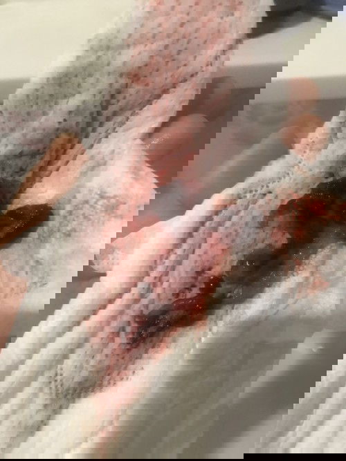 แบบนี้เรียกพุงปลาใช่มั้ยคะ แท้งโดยสมบูรณ์แล้วใช่มั้ยคะ