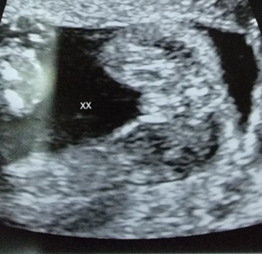 Is this a girl ultrasound at 20 weeks? Just to confirm and reassure