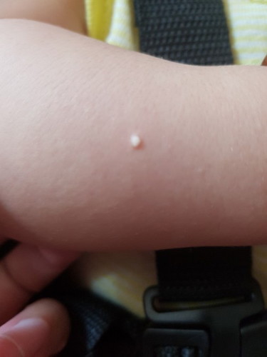 Hi, my naka experience na po ba tulad ky LO nila after kinagat ng insect?I use tiny buds after bites