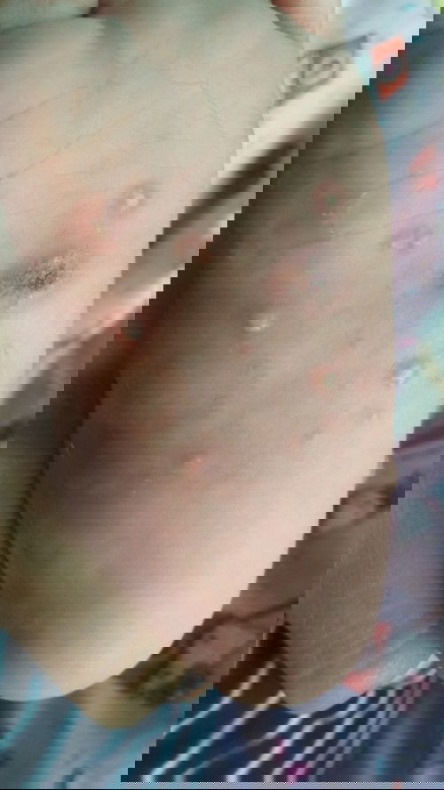 Obat  sembuh pada kaki bayi