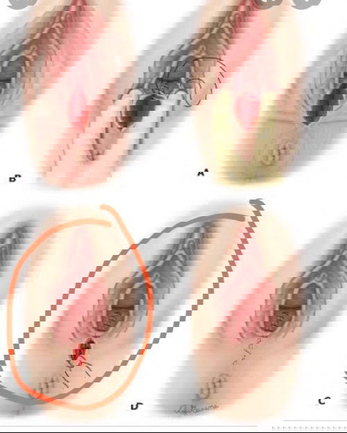 คลอดลูกได้1เดือน​ เจ็บแสบที่แผลเย็บ​(แผลเปิด)​