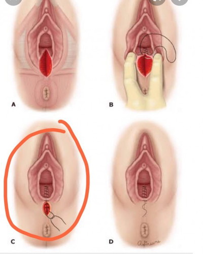 คลอดลูกได้1เดือน เจ็บแสบที่แผลเย็บ(แผลเปิด)