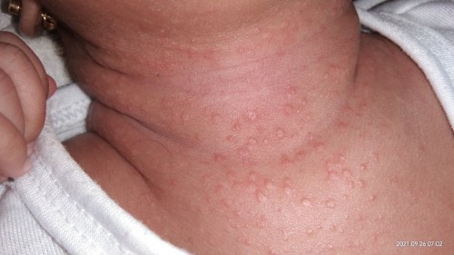 normal lang po ba tong butlig sa leeg ni baby?