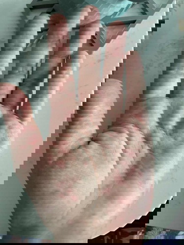 Red spots on palms