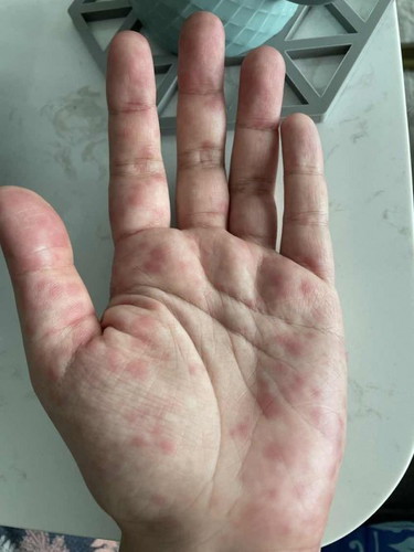 Red spots on palms