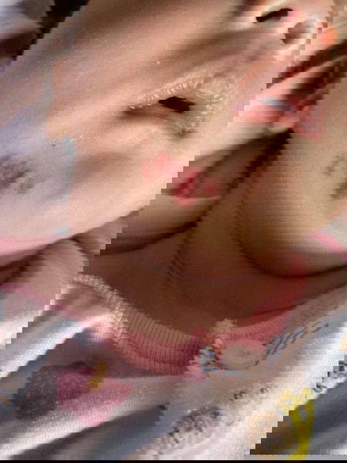 มีบ้านไหนน้องเป็นปานแดงแบบนี้บ้าง