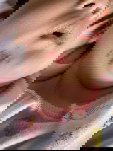 มีบ้านไหนน้องเป็นปานแดงแบบนี้บ้าง