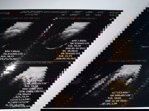 Hpl usg hpl bidan beda