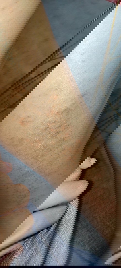 Gatal biduran hamil 13 minggu