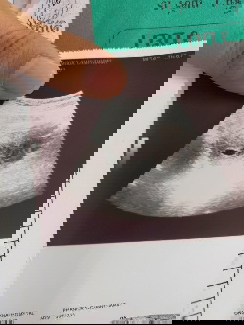 ท้องลม เลือดออกขณะตั้งครรภ์