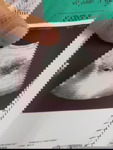 ท้องลม เลือดออกขณะตั้งครรภ์