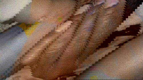 Ada luka di kulit bayi