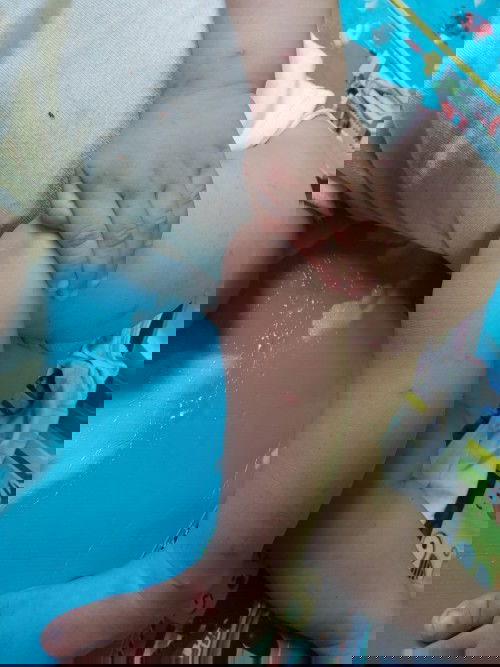 Bentol nanah digigit semut