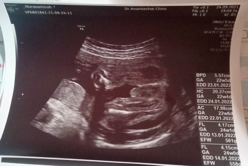 24week ใครดูออกบ้างผู้หญิงหรือผู้ชายแม่ดูไม่ออก แต่หมอบอกว่าผู้ชาย