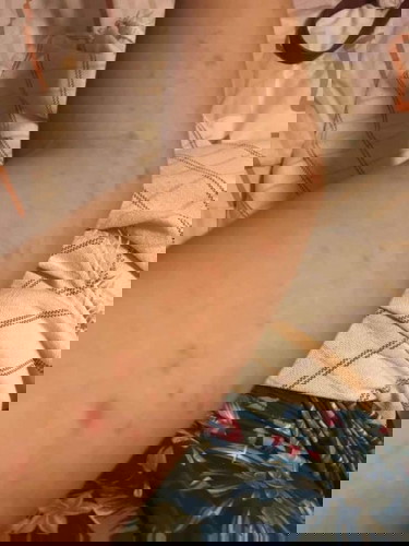 Pruritic Urticarial Papules and Plagues of Pregnancy (29 weeks pregnant)
Who else po naka experience ng ganito?