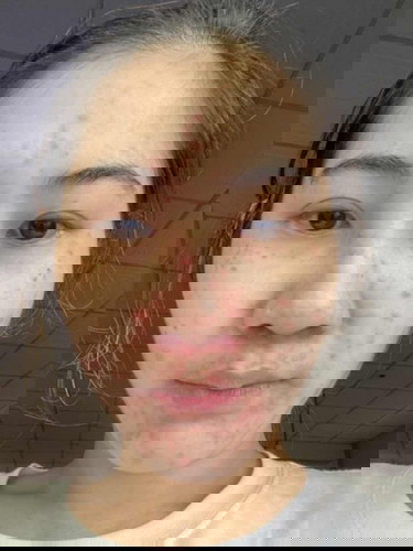 ท้องได้22wสิวอักเสบขึ้นเต็มหน้าเลย พอมีวิธีมั้ยคะ