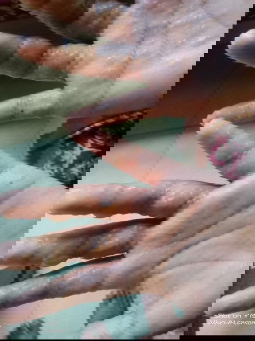 Bun Saat ini saya hamil 9w, telapak tangan saya sangat gatal dan bentol-bentol berisi air dan nanah?