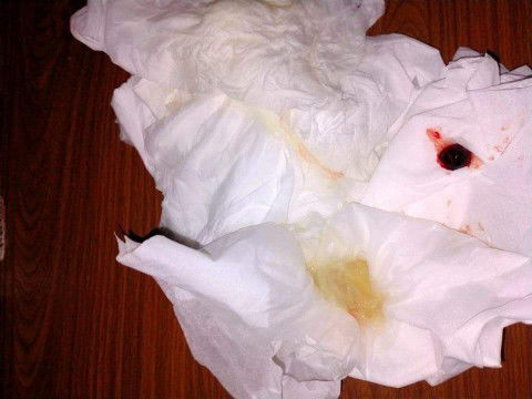 มีเลือดออกแบบนี้ไปหาหมอมั้ยคะ