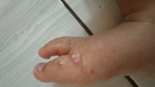 Bubunda mau tanya dong. Adakah yang punya pengalaman scabies pada bayi? Gimana penyembuhan nya?