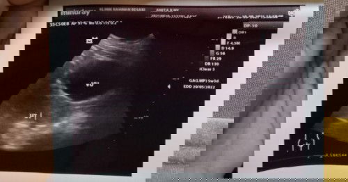 Hasil USG baru ada pembesaran rahim