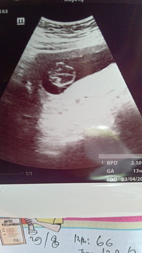 Usia kandungan 13 minggu