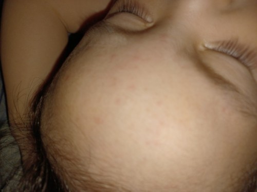 Baby rash on forehoead