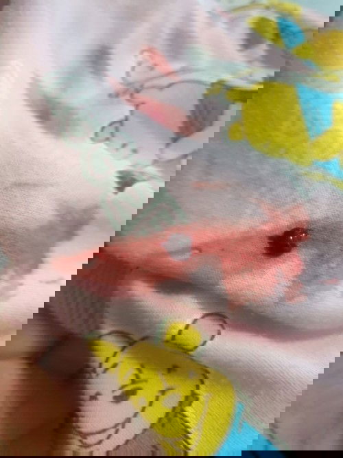 ภาวะแท้งคุกคามสอบถามค่ะ