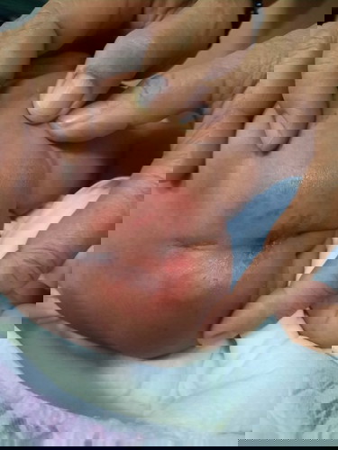 Con e 20 ngày bị vậy có cách nào trị ko ạ. E xót quá