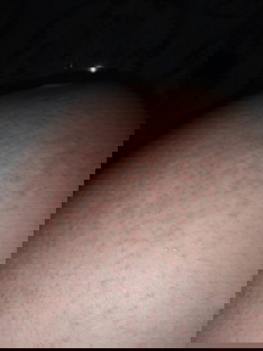 เป็นผื่นคันมาก