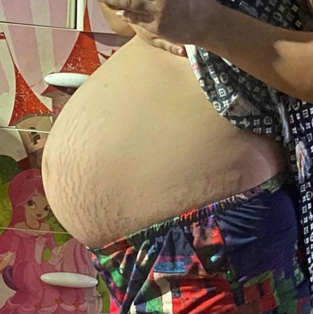 Cko e hỏi bụng như nài sụt chưa ạ
