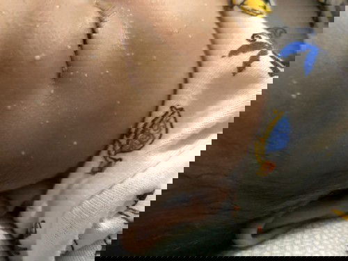 Bruntusan pada wajah