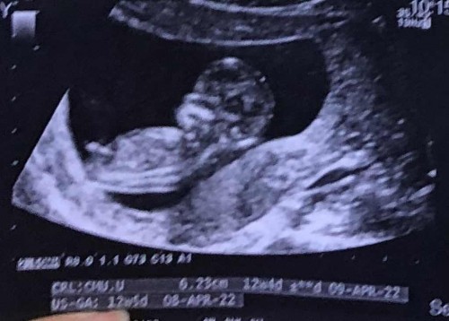 เรื่องอัลตราซาวด์