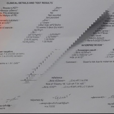 เจาะเลือดตรวจดาวน์ซินโดม