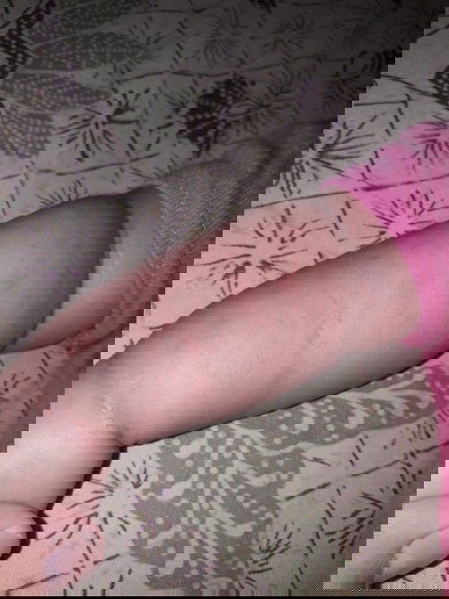 Ini ruam atau apa yah mom