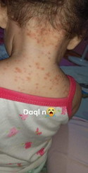 Baby grid rashes